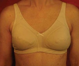 Federated Healthcare Supply - Bra Post Mastectomy Soft Cup 42A